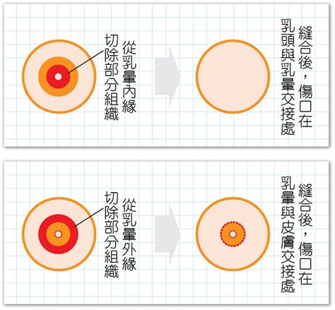 乳暈 黑點|女性正常乳暈直徑3